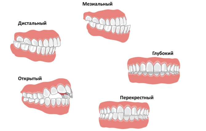 Druhy malocclusion