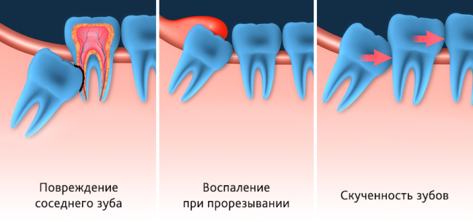 Types de dentition de sagesse