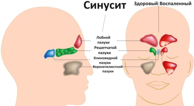 Druhy sinusitidy