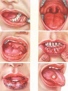 Types de stomatite