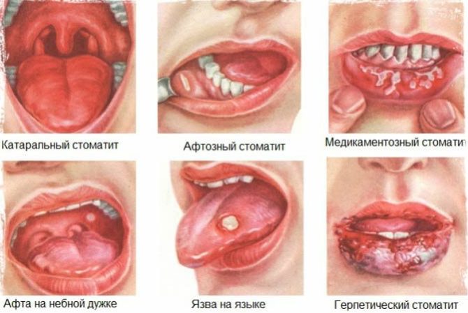 Mga uri ng Stomatitis