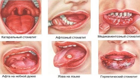 Mga uri ng Stomatitis