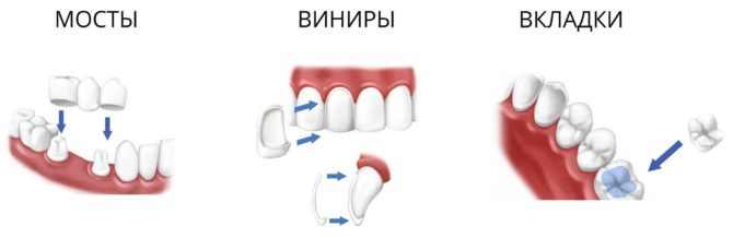 Types de prothèses dentaires