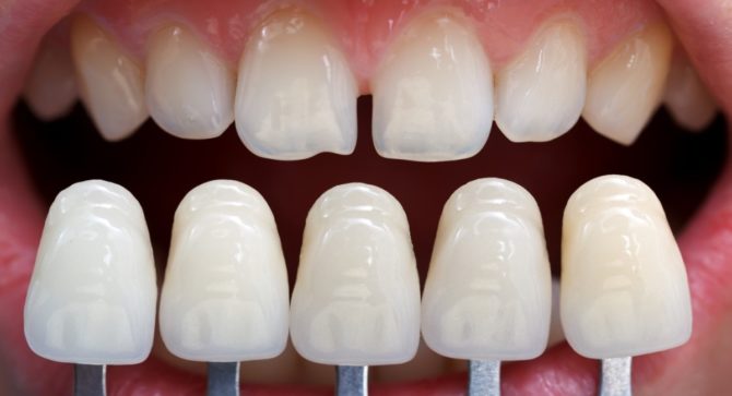 Mga Dental Veneer