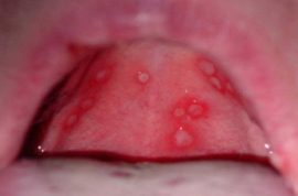 Viral stomatitis