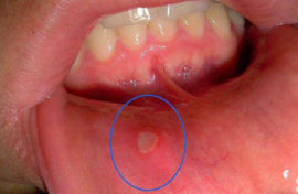 Viral stomatitis