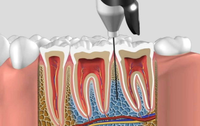 Intraosseous anesthesia