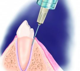 Intrafigurative anesthesia