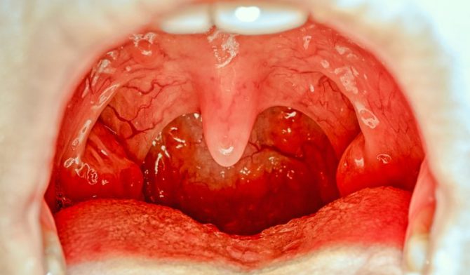 Inflammation des glandes