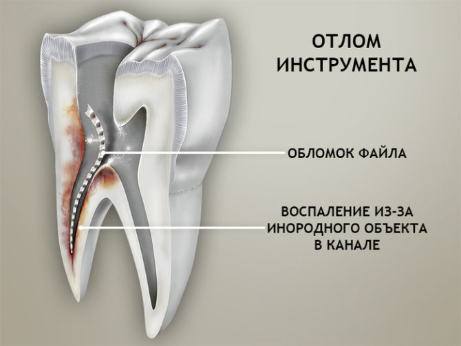 Inflammation des tissus mous due à des débris de limes