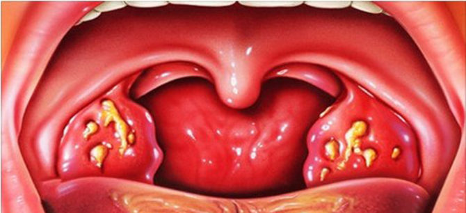 Ang mga namamaga na tonsil na may purulent na nilalaman