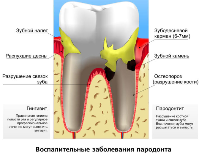 Namamaga na periodontal disease