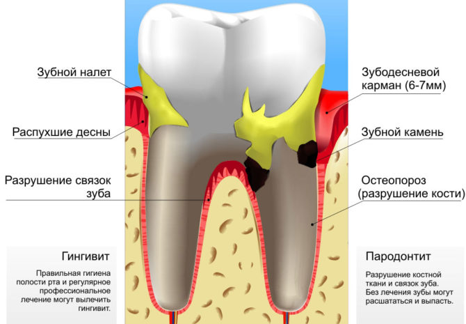 Namamaga na periodontal disease