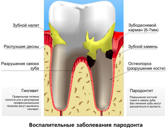 Namamaga na periodontal disease