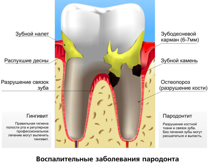 Maladie parodontale inflammatoire