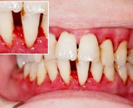 Dommages liés au diabète pour les dents