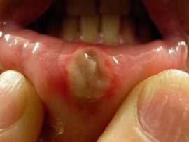 Ulcerative necrotic stomatitis