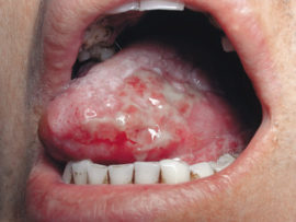 Ulcerative glossitis