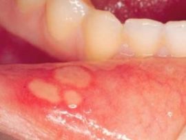 Ulserative na stomatitis