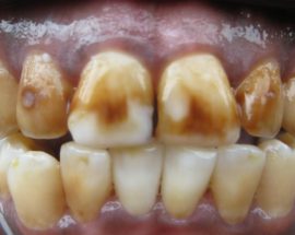 Running tooth fluorosis