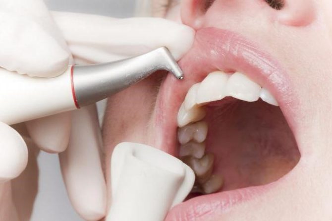 La dernière étape du brossage des dents utilisant la technologie Air Flow