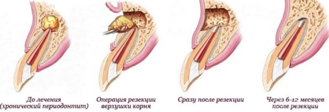 Pagaling sa tissue pagkatapos ng resection