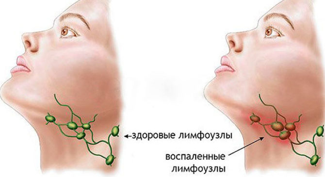 Malusog at namumula lymph node