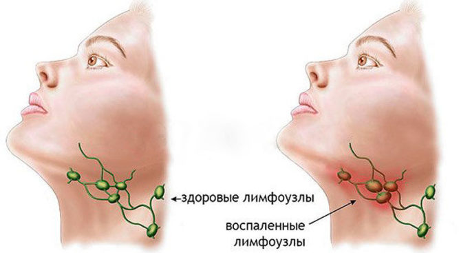 Malusog at namumula lymph node