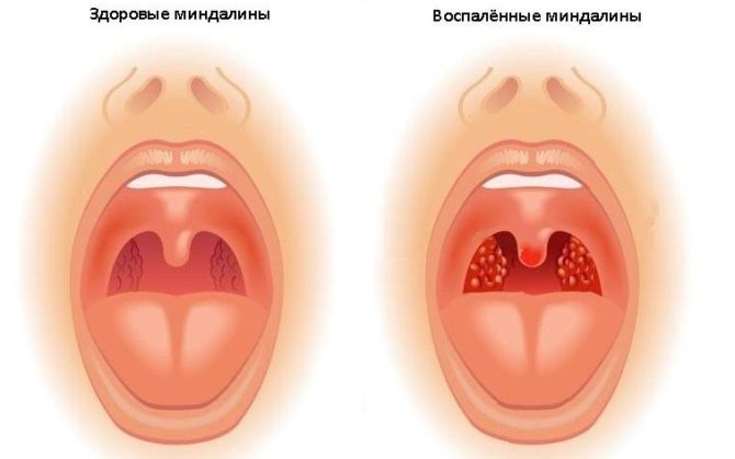 Malusog at namamagang tonsil