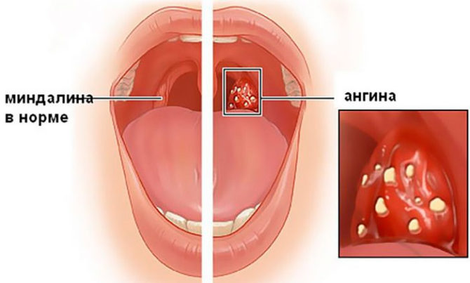 Malusog at namamagang tonsil