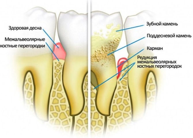 Malusog na ngipin at sakit sa periodontal