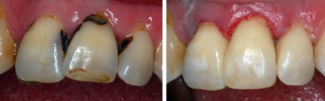 Ngipin na may mga cervical caries bago at pagkatapos ng paggamot