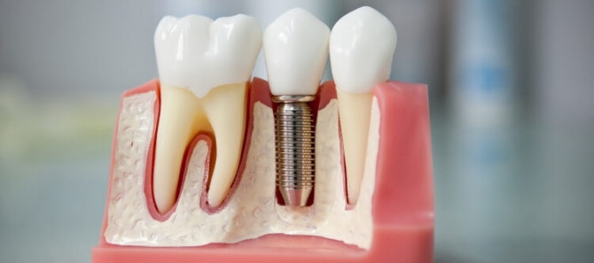 Dental implants at maginoo ngipin