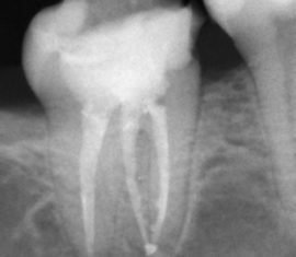 Canaux dentaires à rayons X