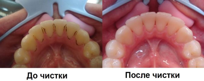 Dents avant et après le nettoyage aux ultrasons