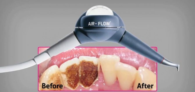 Zuby před a po čištění pomocí technologie Air Flow