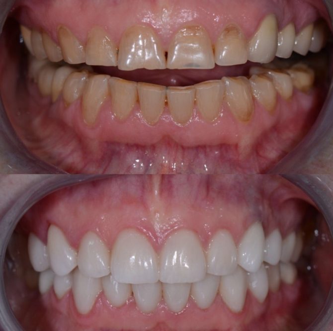 Dents avant et après la pose de couronnes en zirconium