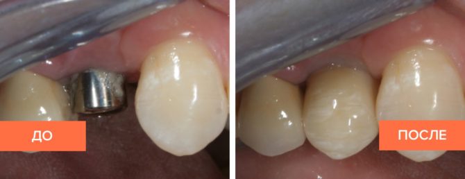 Dents avant et après la mise en place des couronnes en zirconium sur les implants