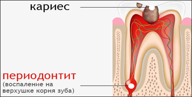 Ano ang periodontitis?