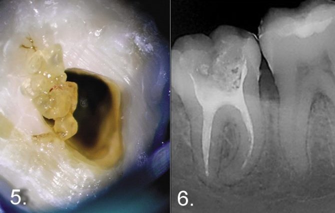 Ang mga denticle sa pulp sa x-ray