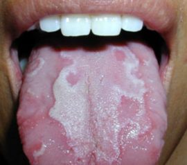 Desquamative glossitis