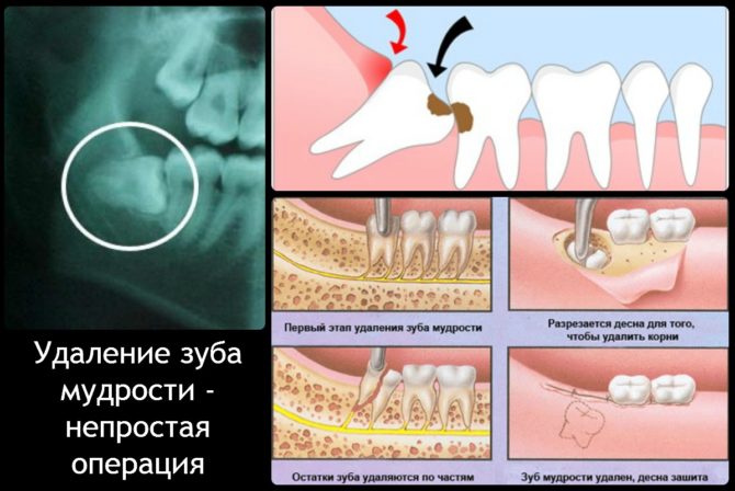 Étapes de l'extraction complexe des dents de sagesse