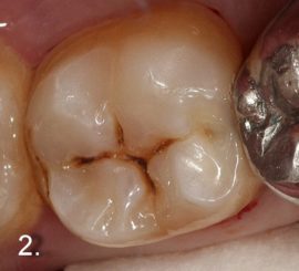 L'image de la pulpite sur les dents