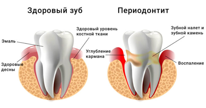 Ano ang hitsura ng periodontitis at isang malusog na ngipin