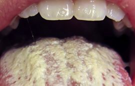 Candidiasis glossitis