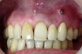 Cyst sa gum