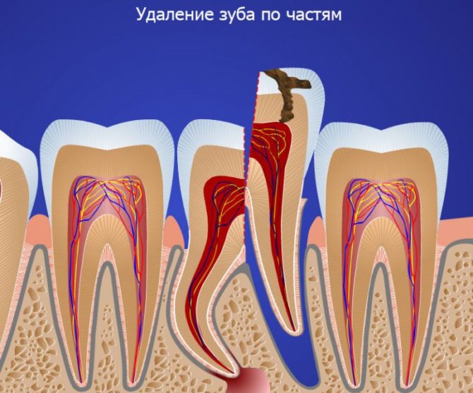 Extraction de dents de sagesse au laser en plusieurs parties