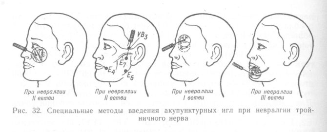 Mga pamamaraan para sa pagpapakilala ng mga karayom ​​ng acupuncture para sa trigeminal neuralgia