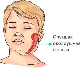 Namamaga na parotid gland