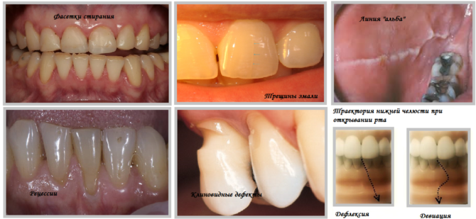 Mga palatandaan ng Bruxism